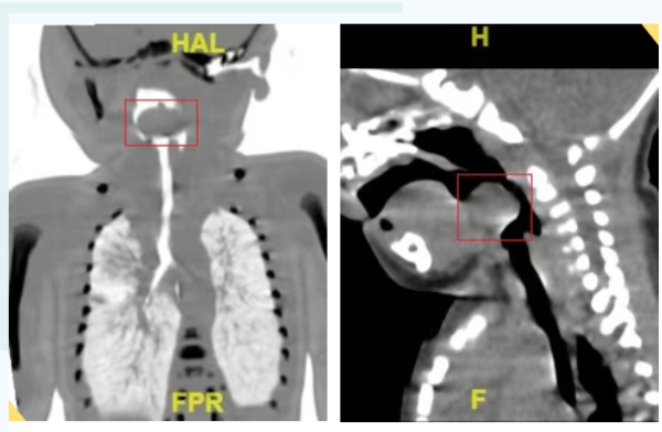配资官方网站 临沂市妇幼保健院纤支镜引导下为新生儿会厌处拆巨大“定时炸弹”